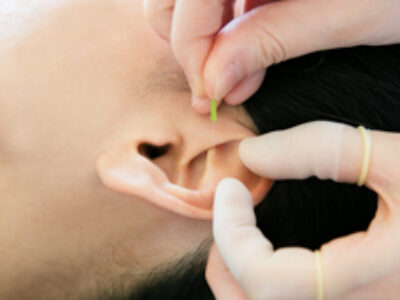 ear-acupuncture